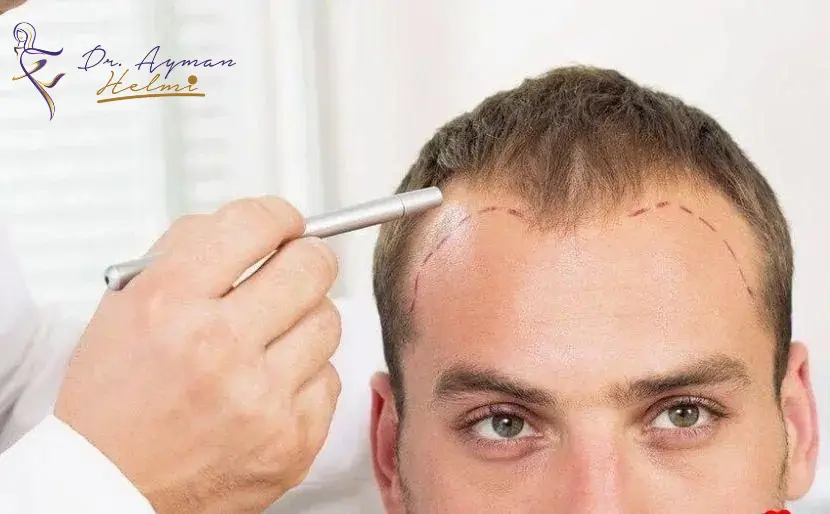 يعاني الكثير من الرجال والنساء في السعودية من مشكلة تساقط الشعر، وقد أصبحت عملية زراعة الشعر الحل الأمثل لهذه المشكلة. 