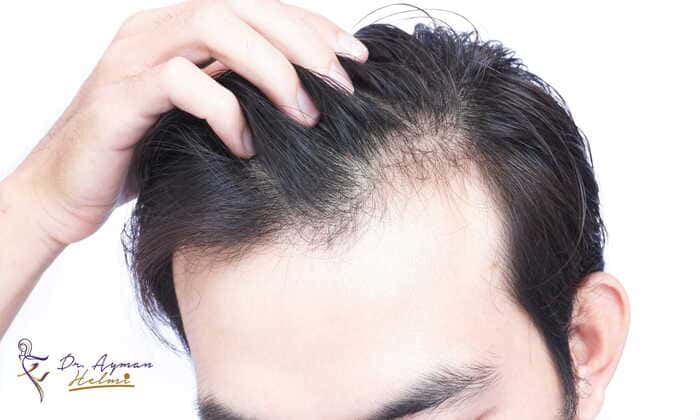 نصائح للحفاظ على نتائج زراعة الشعر